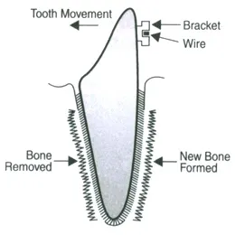 Brace-work